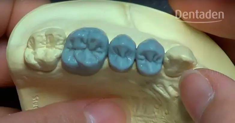 curso de encerado dental - Cómo se hace un encerado dental