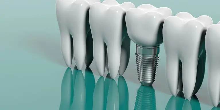 curso de implantes dentales - Cuánto dura la carrera de implantología