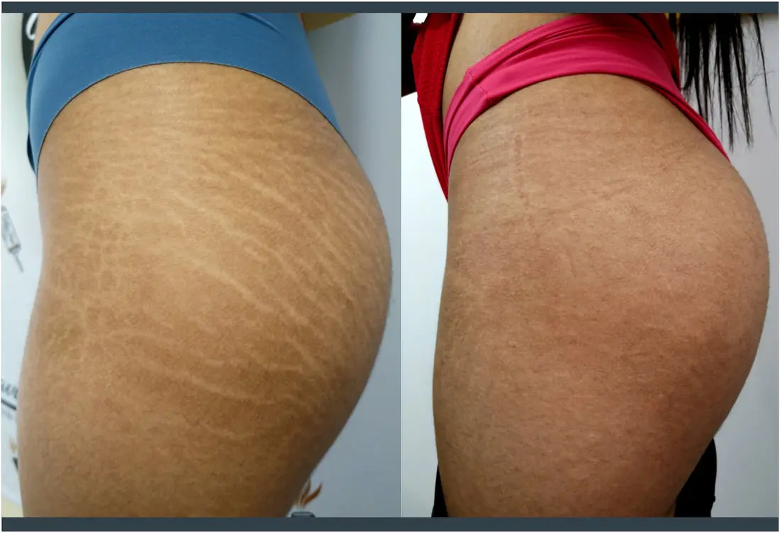 camuflaje de estrias curso - Cuánto dura un camuflaje de estrías