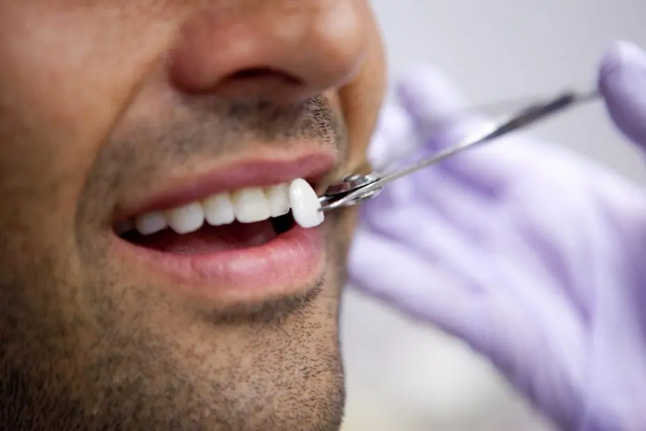 curso carillas dentales - Qué precio tienen las carillas dentales en Estados Unidos