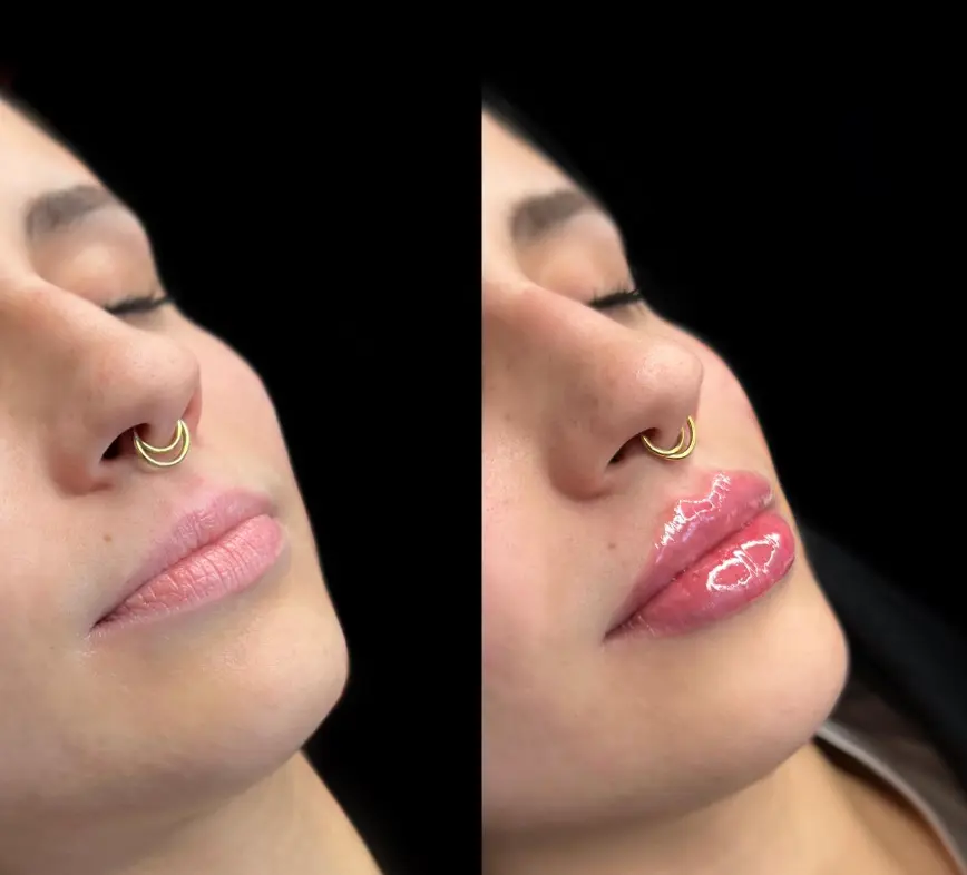 curso de aplicacion de acido hialuronico - Qué profesionales pueden pinchar ácido hialurónico