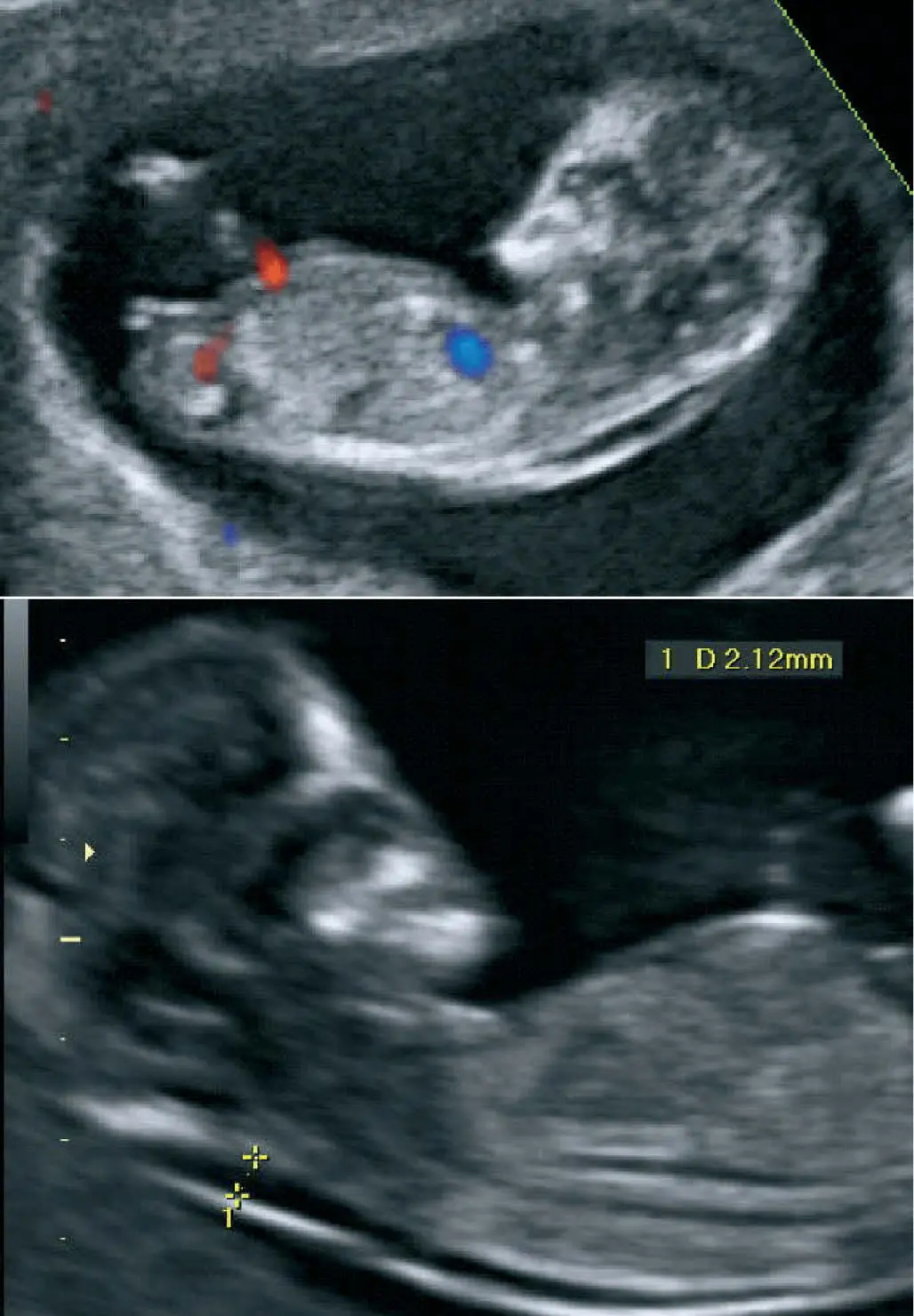 curso de ecografia obstetrica gratis - Qué se puede ver en la ecografía obstétrica